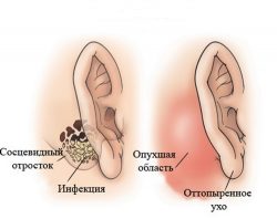 Фурункул слухового прохода