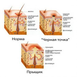 Фурункул под кожей